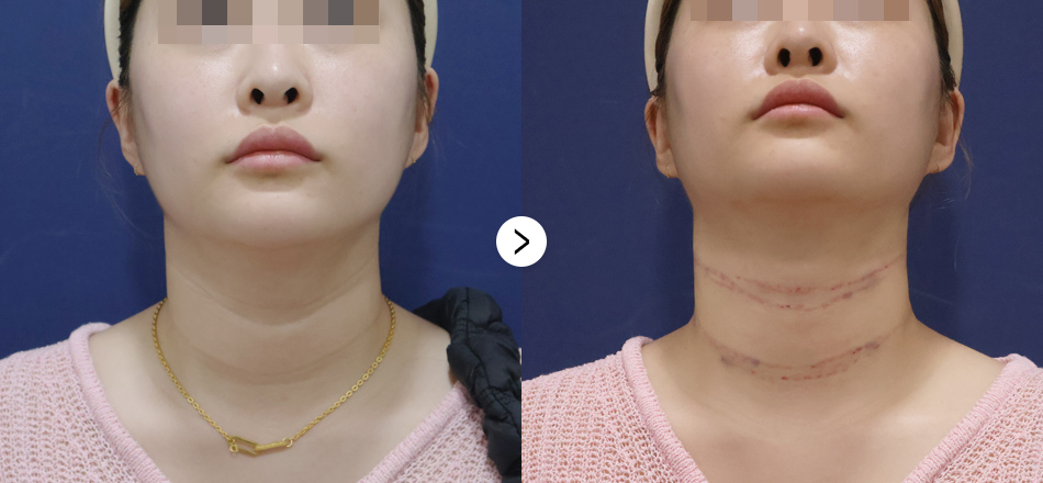 케이톡스 전후사진