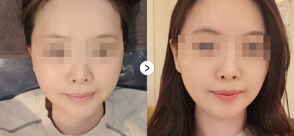 케이톡스 전후사진