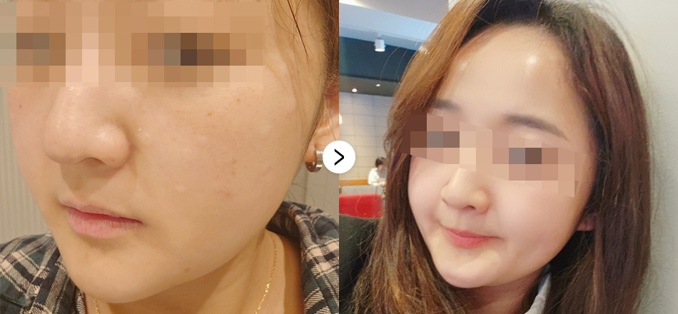 케이톡스 전후사진