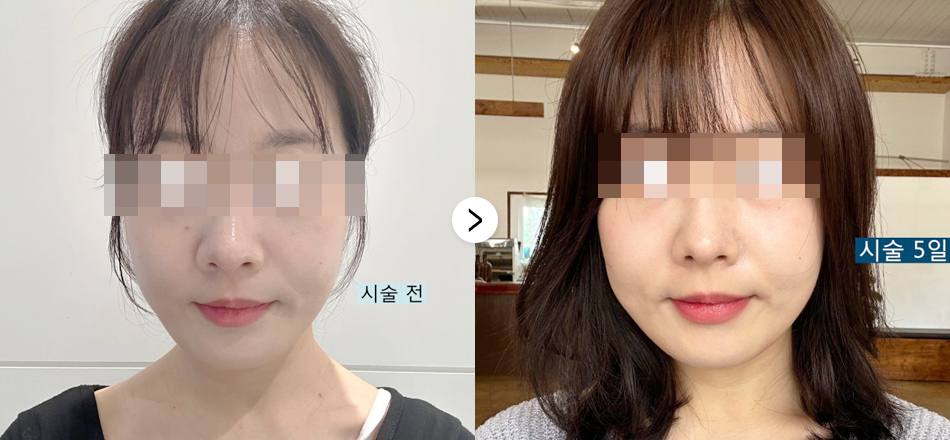 케이톡스 전후사진