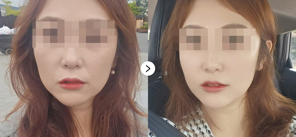 케이톡스 전후사진