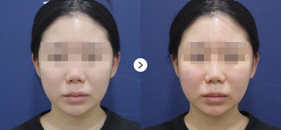 케이톡스 전후사진