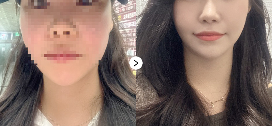 케이톡스 전후사진