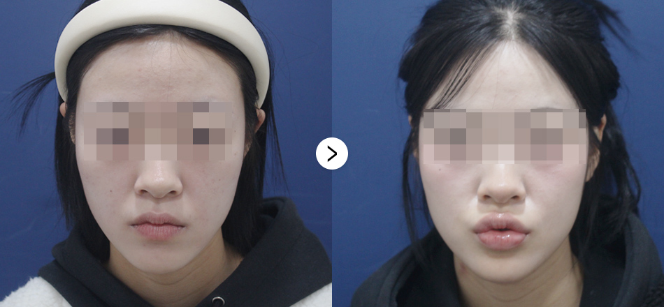 케이톡스 전후사진