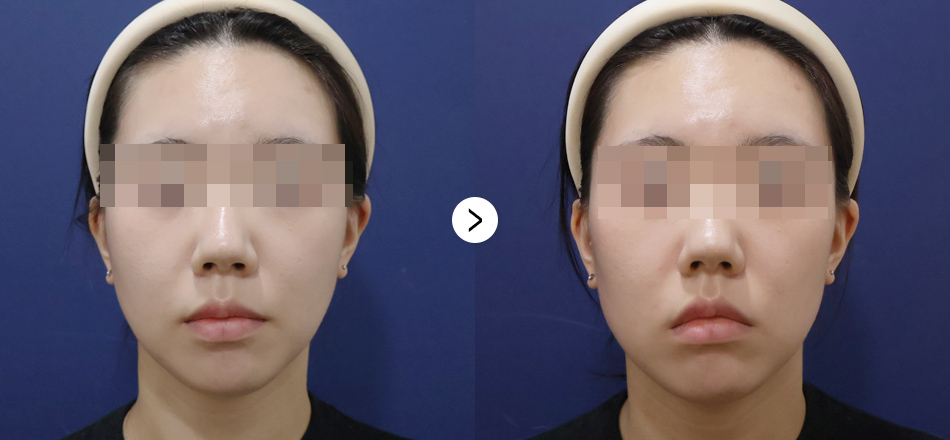 케이톡스 전후사진