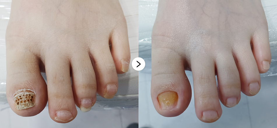 케이톡스 전후사진