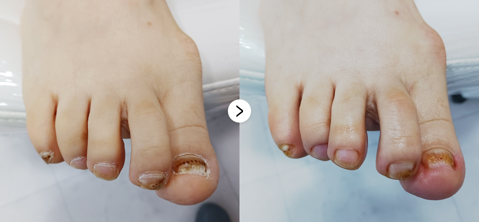 케이톡스 전후사진