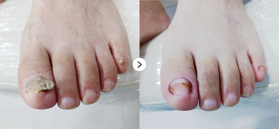 케이톡스 전후사진