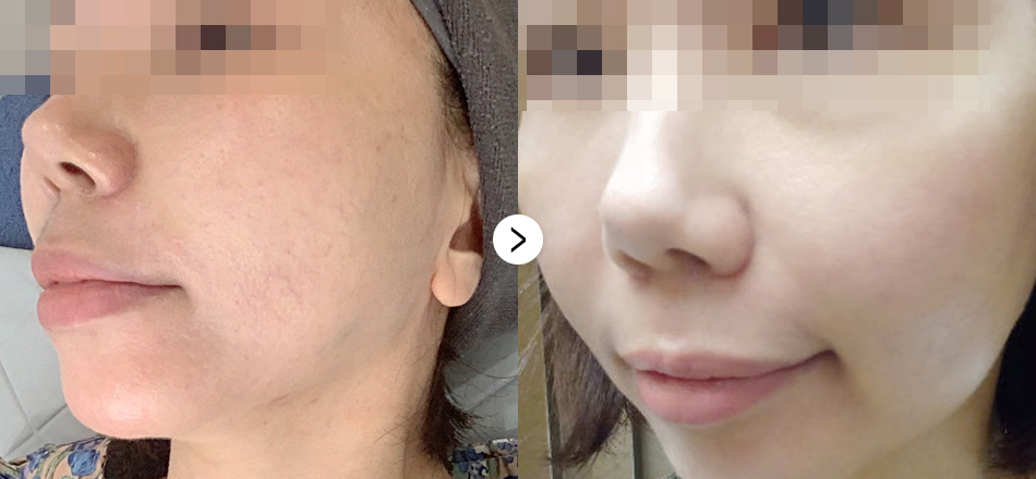 케이톡스 전후사진