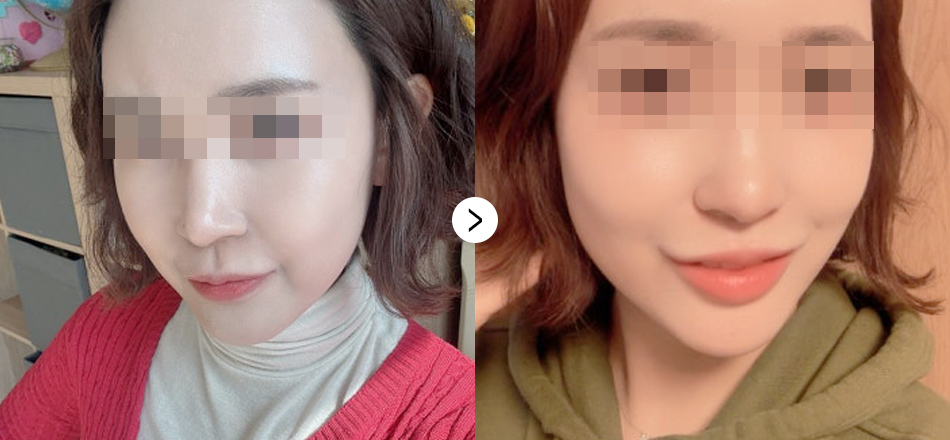 케이톡스 전후사진