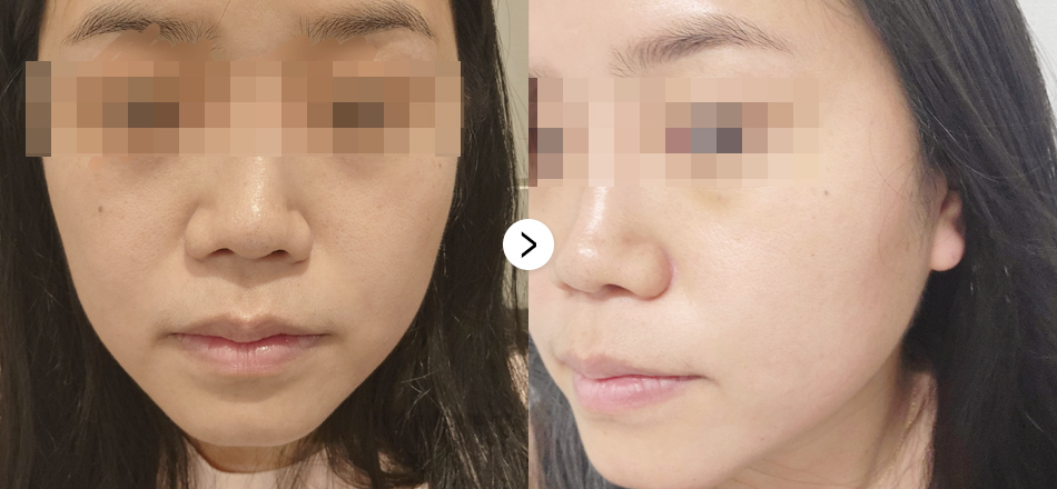 케이톡스 전후사진