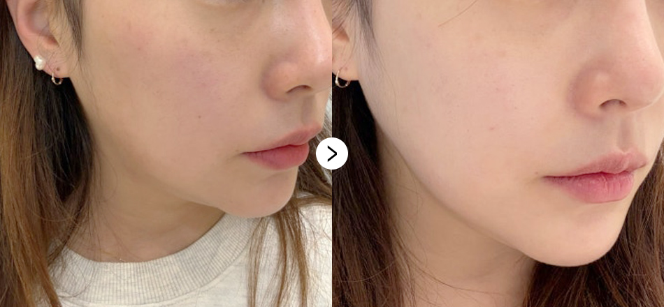 케이톡스 전후사진