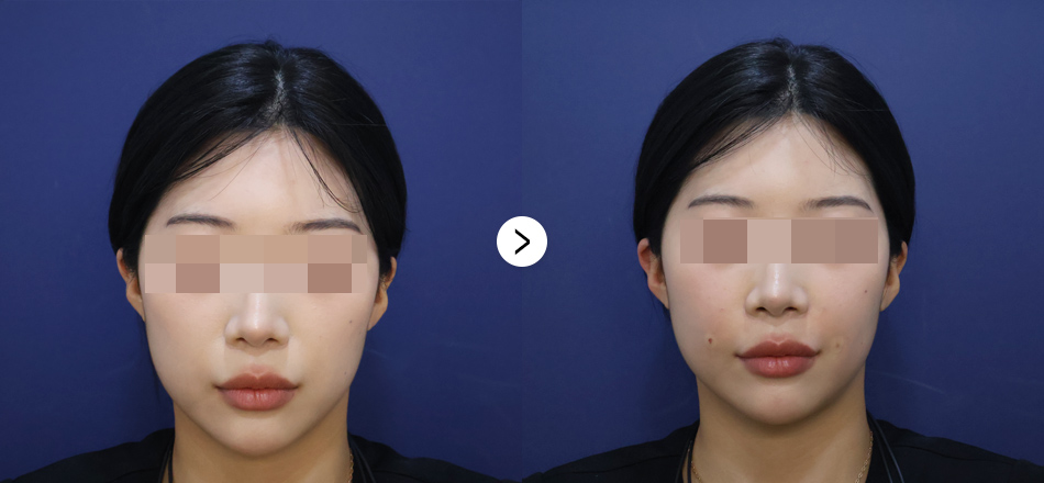 케이톡스 전후사진