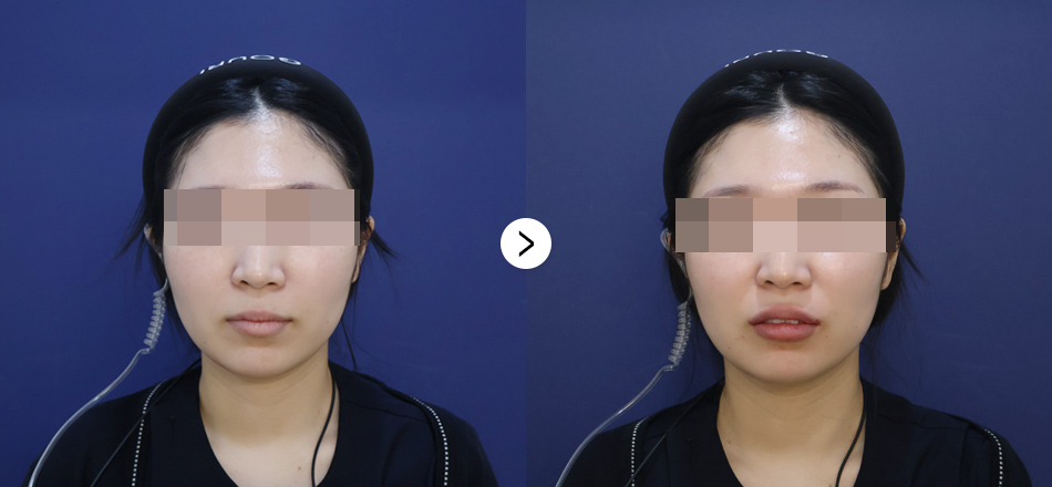 케이톡스 전후사진