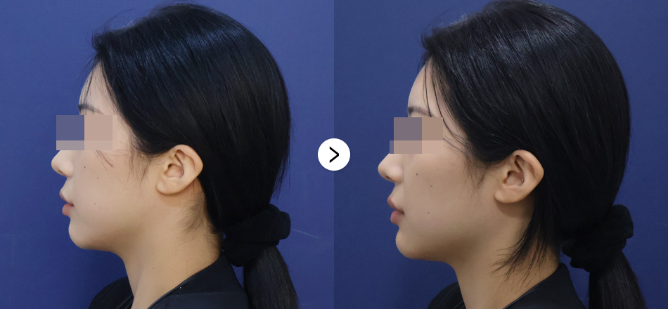 케이톡스 전후사진