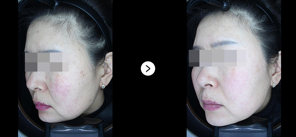 케이톡스 전후사진