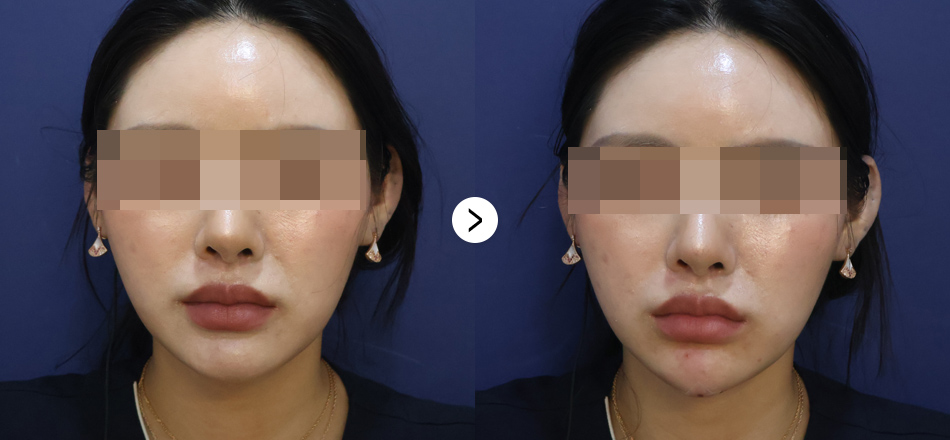 케이톡스 전후사진