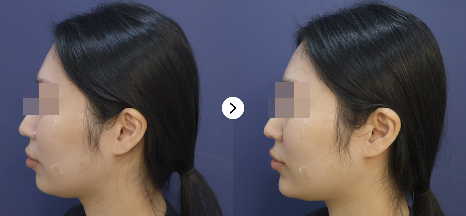 케이톡스 전후사진