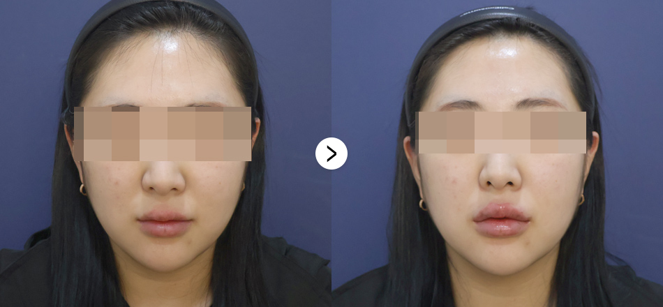 케이톡스 전후사진