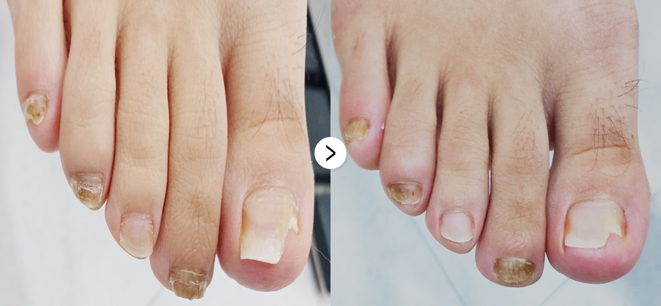 케이톡스 전후사진