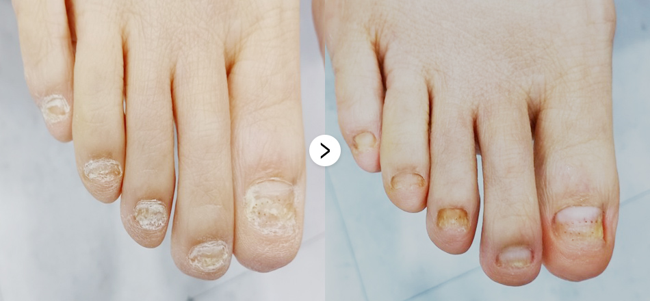 케이톡스 전후사진