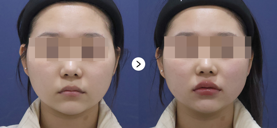 케이톡스 전후사진