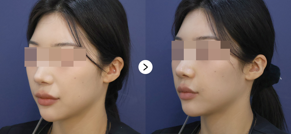 케이톡스 전후사진